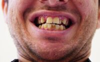 Invisalign pris