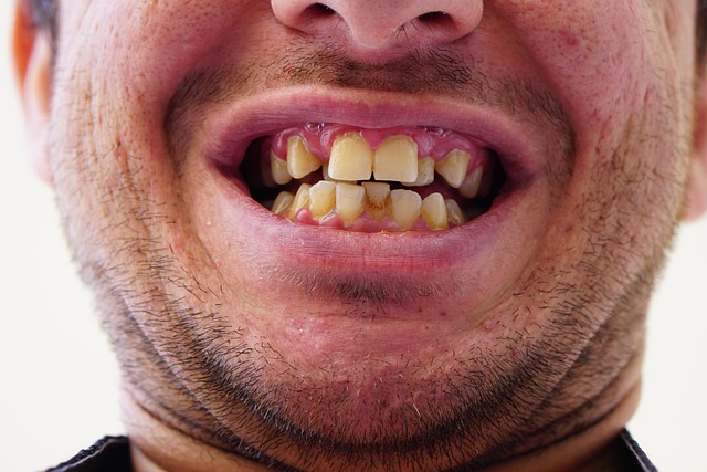 Invisalign pris